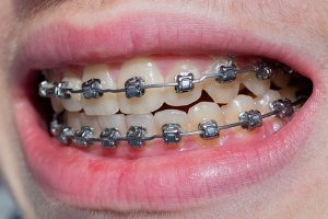 Metal Orthodontic Brackets correct crossbite