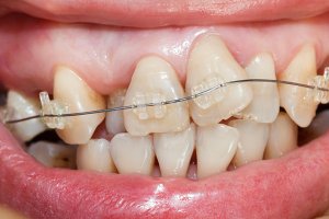 Clear Orthodontic Brackets correct crowded teeth