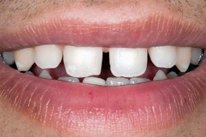 Large spaces between teeth