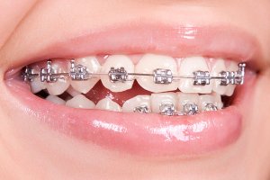 Metal Orthodontic Brackets correct open bite problem