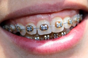 Metal orthodontic brackets correct overbite