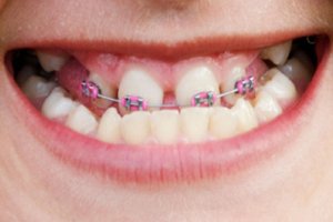 Metal Orthodontic Brackets Correct Underbite